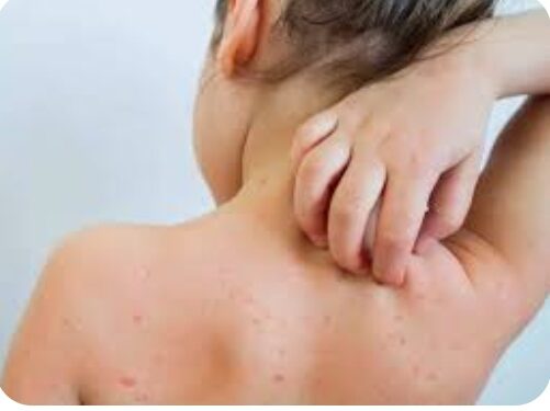 जिल्ह्यात आजपासून गोवर रुबेला विशेष लसीकरण मोहीम