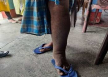 हत्तीपाय रुग्णानाही मिळणार दिव्यांगाच्या सर्व सुविधा