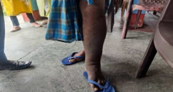 हत्तीपाय रुग्णानाही मिळणार दिव्यांगाच्या सर्व सुविधा